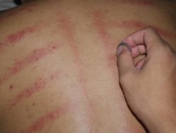 Dampak Kerokan yang Perlu Diwaspadai untuk Kesehatan